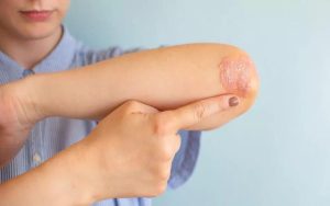 How UVBMEDI products can help you deal with psoriasis