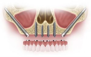 Pterygoid Implants in Albania Who Are They For