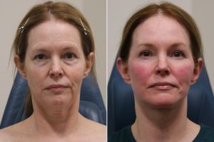 Which Facelift and Tightening Methods Provide the Longest-lasting Results