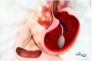Gastric Bypass