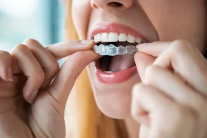 Clear Aligners