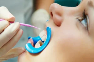 Sealants